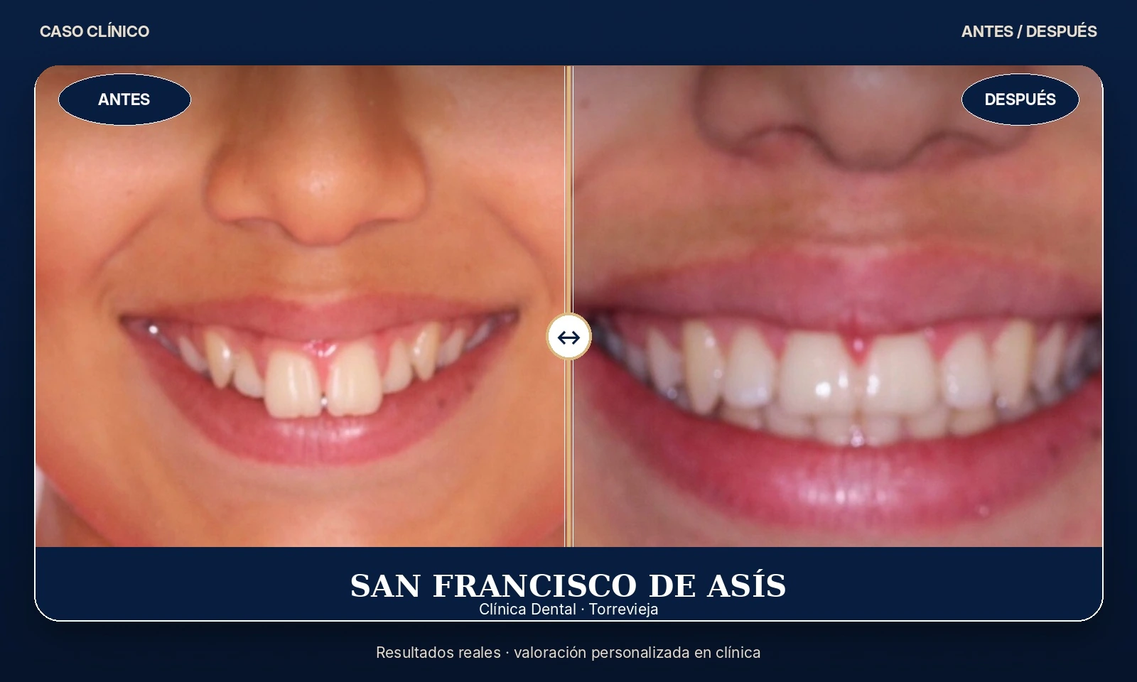 Caso clínico 01 antes y después de tratamiento dental