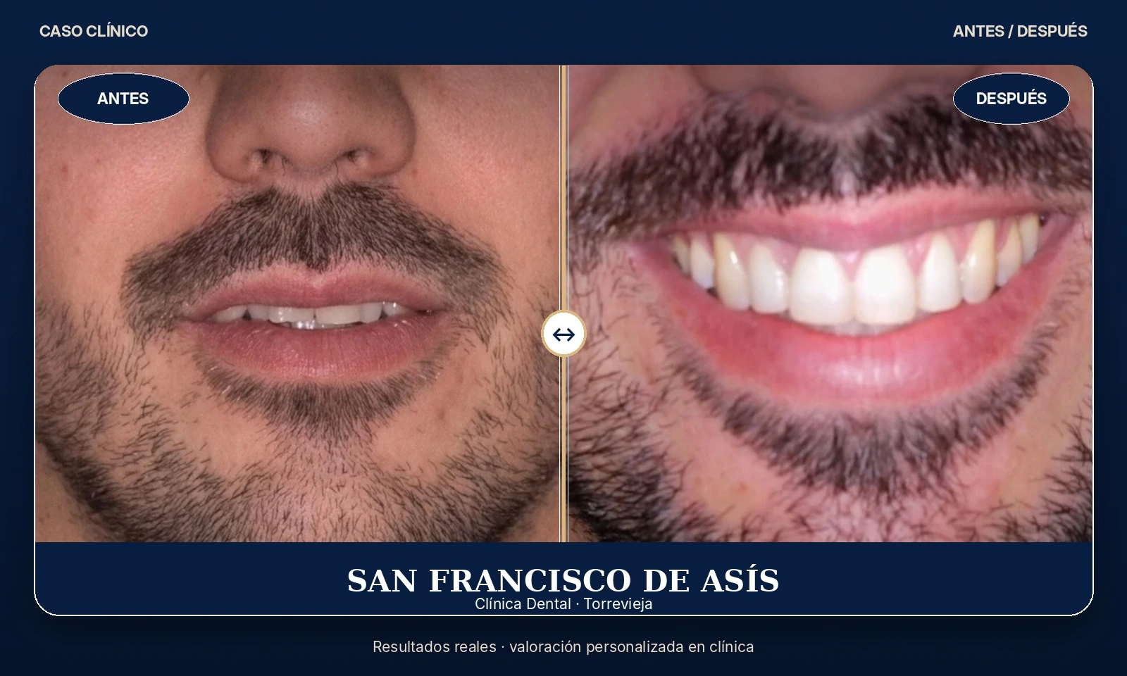 Caso clínico 02 antes y después de tratamiento dental