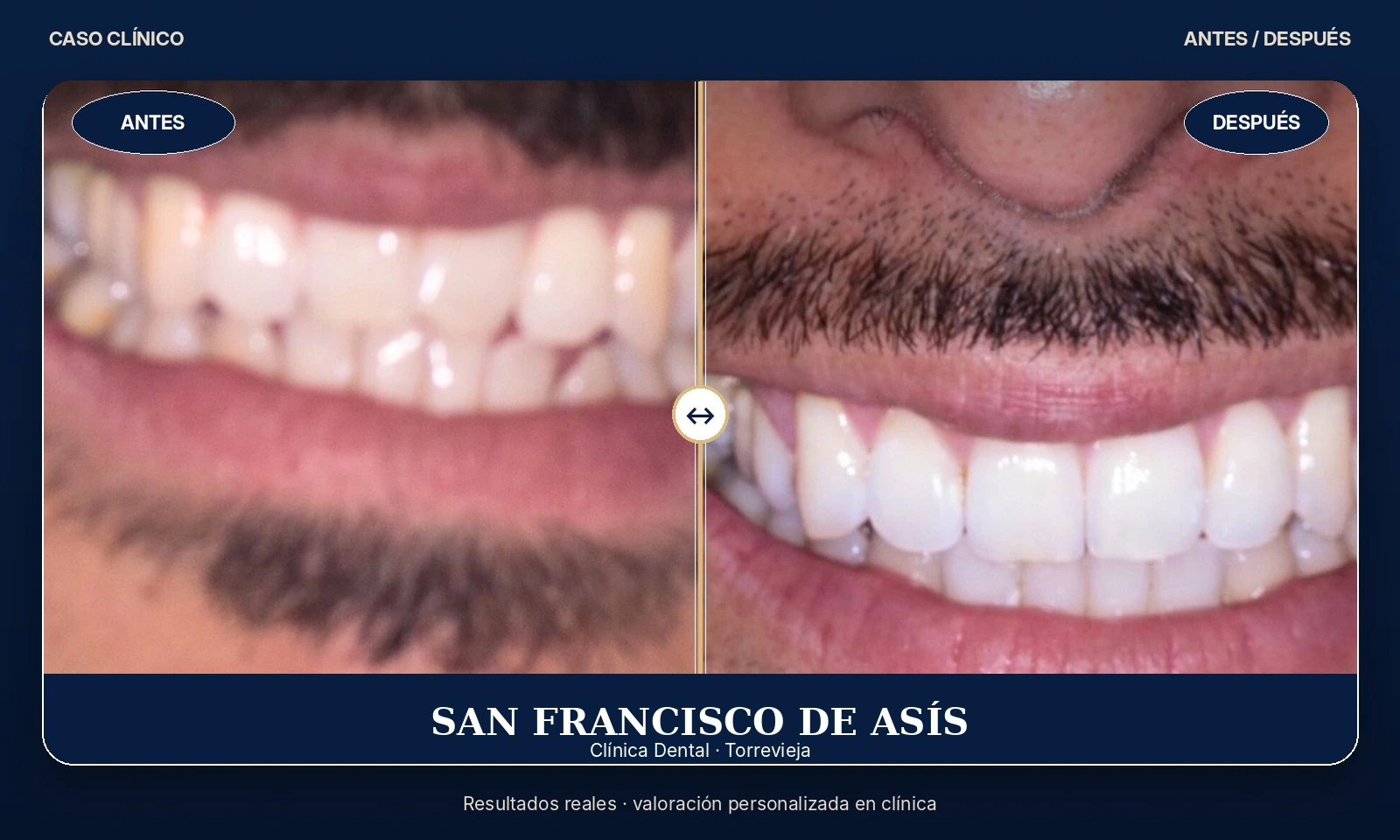 Caso clínico 03 antes y después de tratamiento dental
