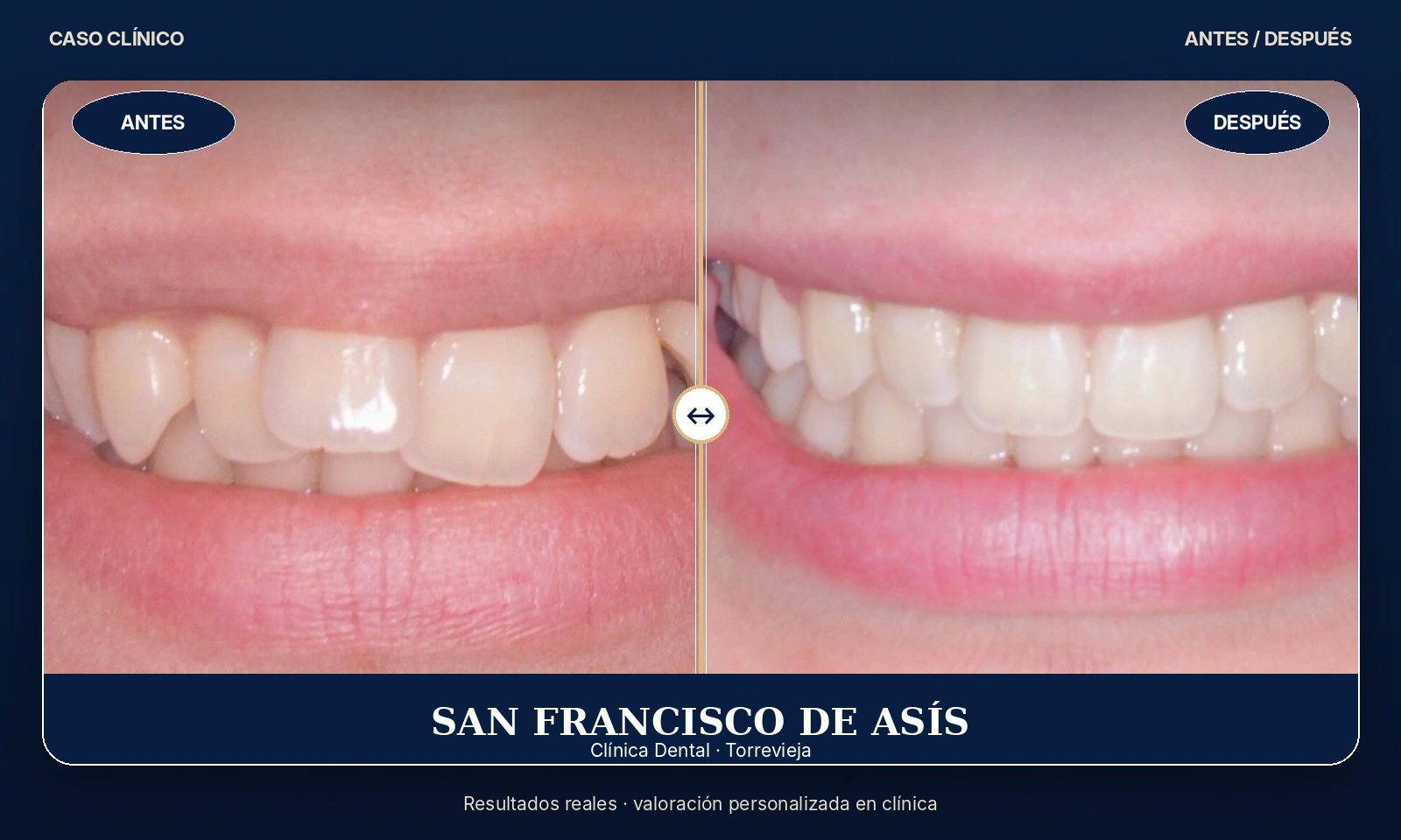 Caso clínico 04 antes y después de tratamiento dental