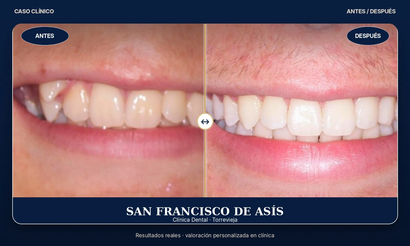 Caso clínico 05 antes y después de tratamiento dental